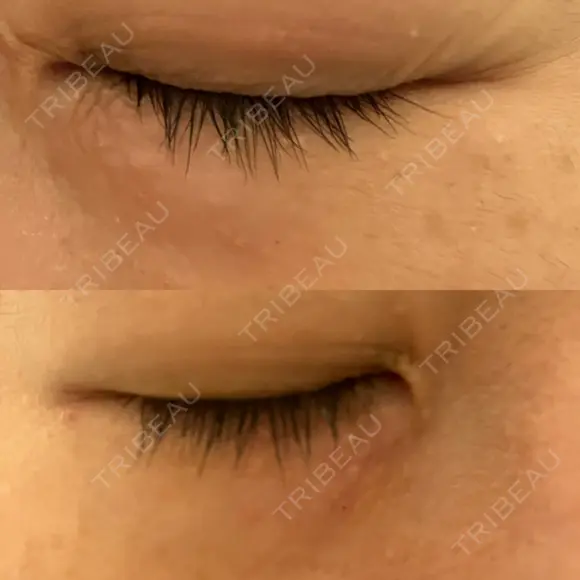 ニードルRF（ポテンツァなど） 表参道スキンクリニック 名古屋院（DAILY SKIN CLINIC提携院） DAY 4 メイン用