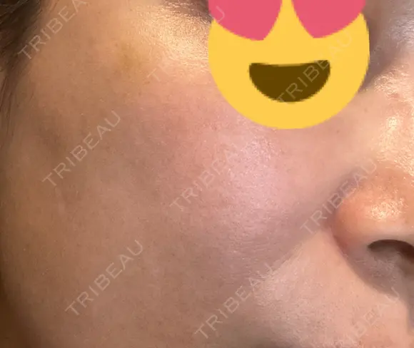 シミ取りレーザー Mavie Beauty Clinic （マヴィービューティークリニック） DAY 30 メイン用