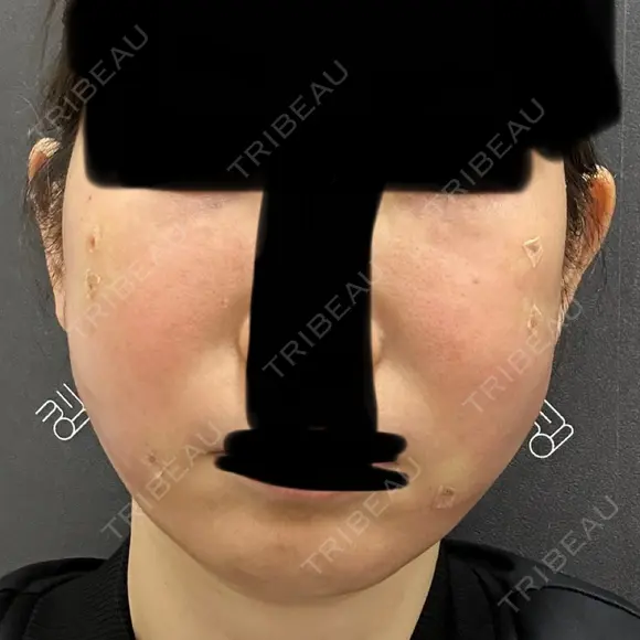 クマ治療 / 脂肪注入（肌） / 脂肪注入（目の下） EMMO FACE CLINIC 大宮院 DAY 0 メイン用