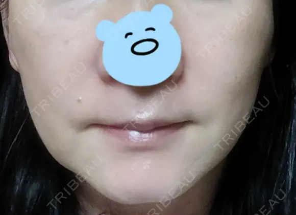 糸リフト 東郷美容形成外科　福岡 DAY 3 メイン用