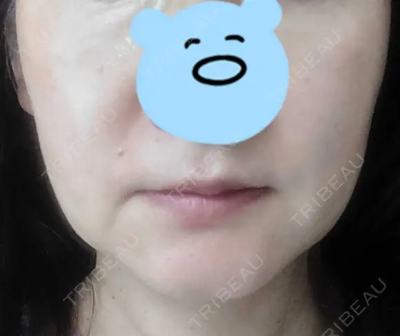 糸リフト 東郷美容形成外科　福岡 DAY 32 メイン用