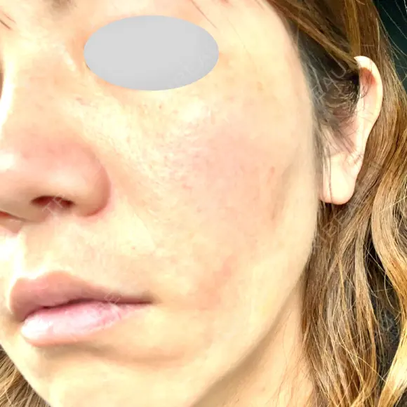 ヒアルロン酸注入（頬） 品川スキンクリニック立川院 AFTER メイン用