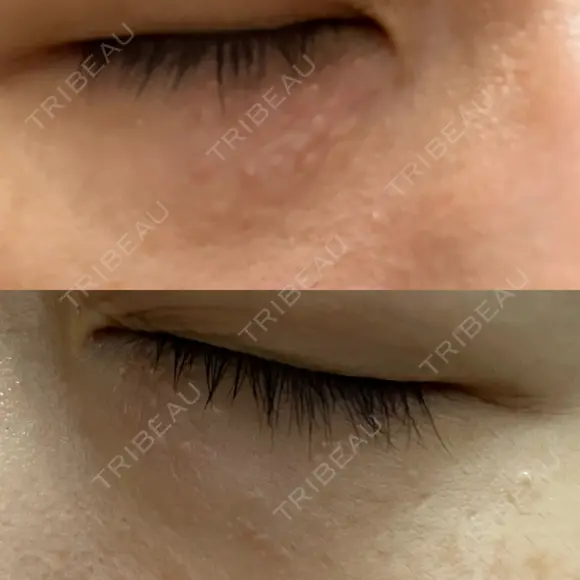 ニードルRF（ポテンツァなど） 表参道スキンクリニック 名古屋院（DAILY SKIN CLINIC提携院） DAY 5 メイン用