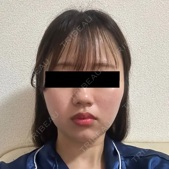 糸リフト / バッカルファット除去 SEA CLINIC（シークリニック） DAY 105 メイン用