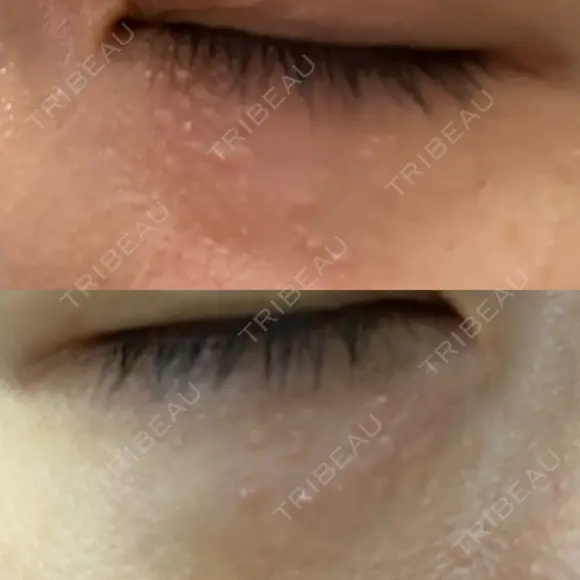 ニードルRF（ポテンツァなど） 表参道スキンクリニック 名古屋院（DAILY SKIN CLINIC提携院） AFTER メイン用