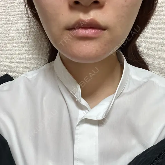 ボトックス（エラ・小顔） 9BeautyClinic AFTER メイン用