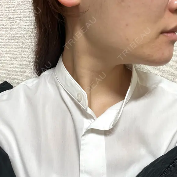 ボトックス（エラ・小顔） 9BeautyClinic DAY 16 メイン用
