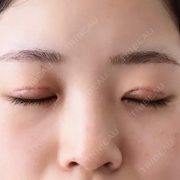 目頭切開 東京エビスクリニック DAY 8 メイン用