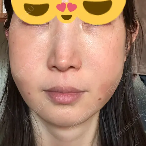 クマ治療 / 脂肪注入（肌） / 脂肪注入（目の下） EMMO FACE CLINIC 大宮院 DAY 2 メイン用