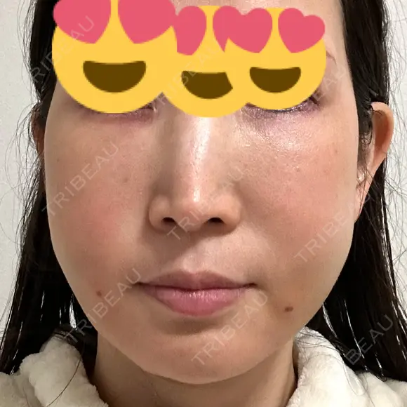 クマ治療 / 脂肪注入（肌） / 脂肪注入（目の下） EMMO FACE CLINIC 大宮院 DAY 3 メイン用