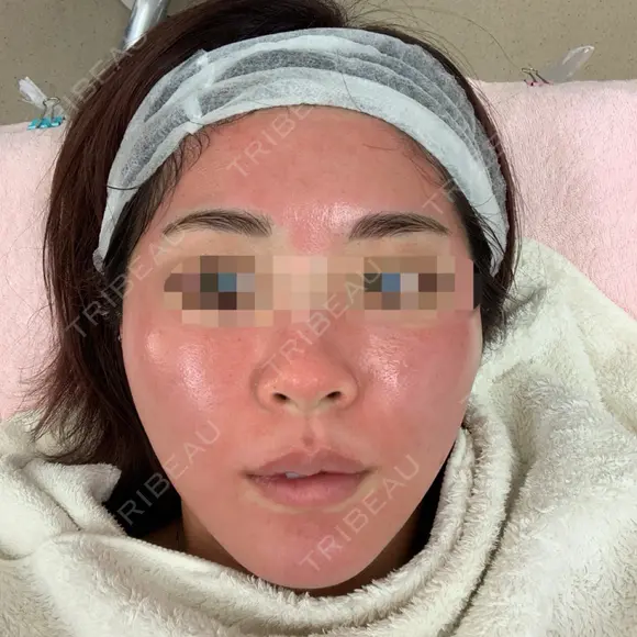 ヴェルヴェットスキン Olino美容外科・美容皮膚科 DAY 0 メイン用