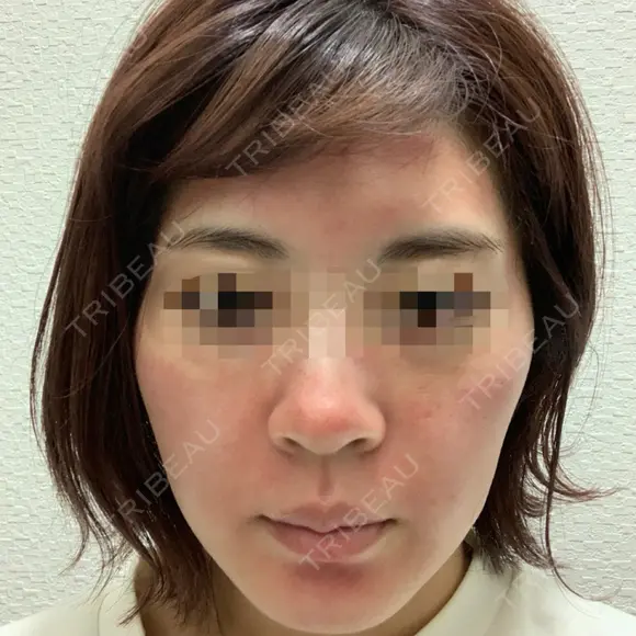ヴェルヴェットスキン Olino美容外科・美容皮膚科 DAY 0 メイン用