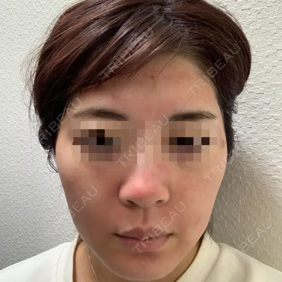ヴェルヴェットスキン Olino美容外科・美容皮膚科 DAY 1 メイン用
