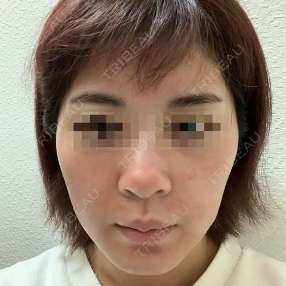 ヴェルヴェットスキン Olino美容外科・美容皮膚科 DAY 1 メイン用