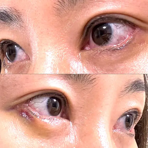 目尻切開 / タレ目形成・グラマラスライン（埋没） / 美容点滴・美容注射（美肌） LOUIS CLINIC 二子玉川院【ルイクリニック】 DAY 3 メイン用