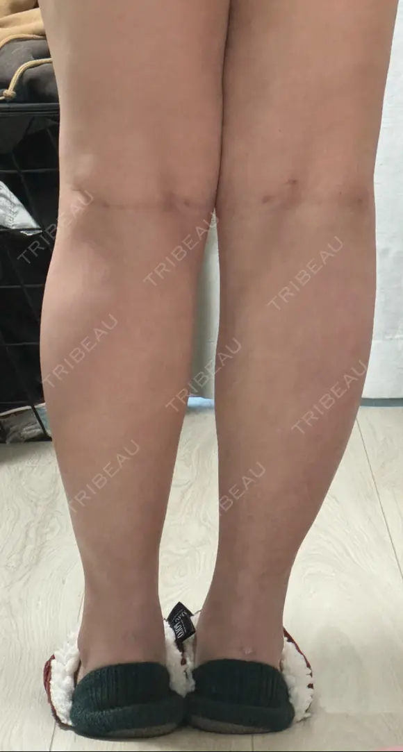 脂肪吸引（二の腕） / 脂肪吸引（脚） / ボトックス（ふくらはぎ） / ボトックス（二の腕） Mods Clinic（モッズクリニック） 福岡院 DAY 28 メイン用