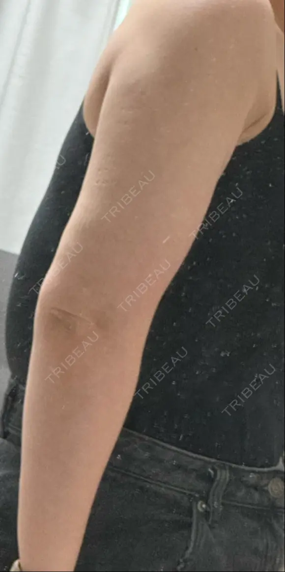 脂肪吸引（二の腕） / 脂肪吸引（脚） / ボトックス（ふくらはぎ） / ボトックス（二の腕） Mods Clinic（モッズクリニック） 福岡院 DAY 28 メイン用