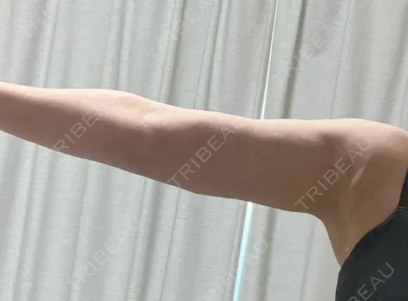 脂肪吸引（二の腕） / 脂肪吸引（脚） / ボトックス（ふくらはぎ） / ボトックス（二の腕） Mods Clinic（モッズクリニック） 福岡院 DAY 28 メイン用