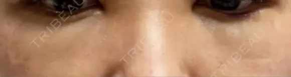 下まぶたたるみ取り エートップ美容整形外科 DAY 3 メイン用