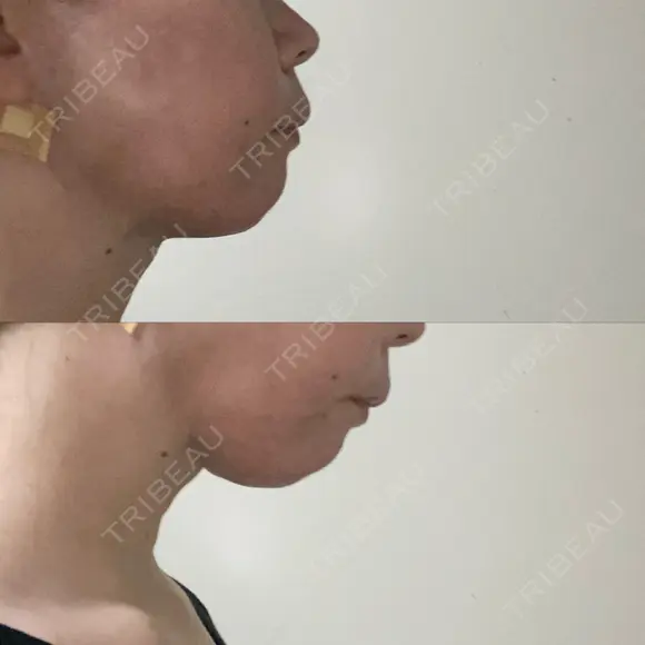 糸リフト / 脂肪吸引（顔） 自由が丘ウェルエイジングビューティークリニック DAY 0 メイン用