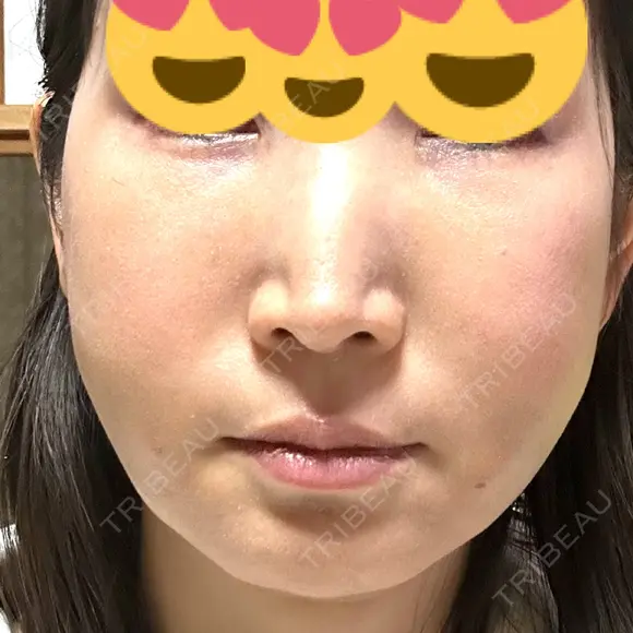 クマ治療 / 脂肪注入（肌） / 脂肪注入（目の下） EMMO FACE CLINIC 大宮院 DAY 4 メイン用