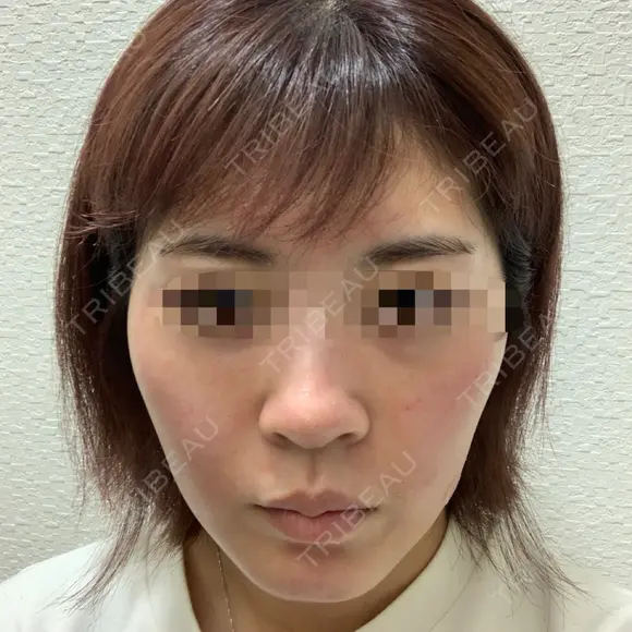 ヴェルヴェットスキン Olino美容外科・美容皮膚科 DAY 2 メイン用