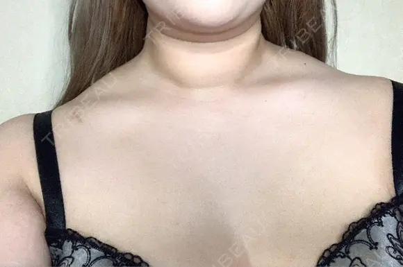 ボトックス（肩） ルラ美容クリニック 横浜院 DAY 0 メイン用