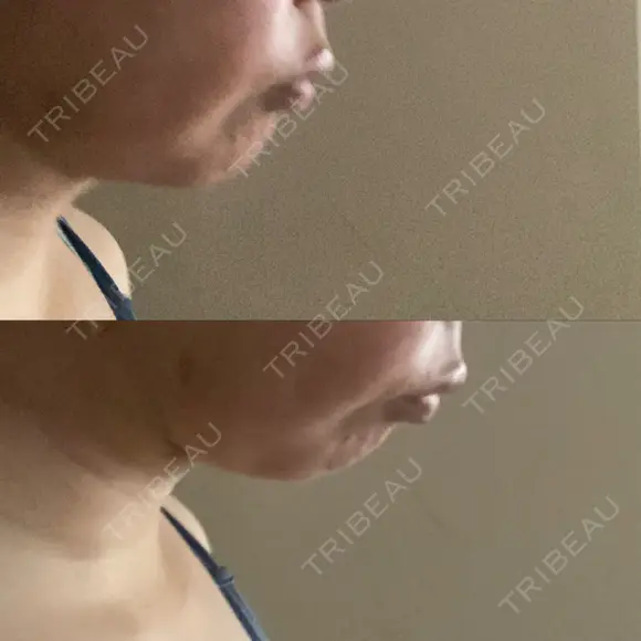 糸リフト / 脂肪吸引（顔） 自由が丘ウェルエイジングビューティークリニック DAY 2 メイン用