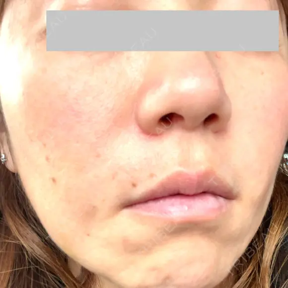 ヒアルロン酸注入（頬） 品川スキンクリニック立川院 DAY 1 メイン用