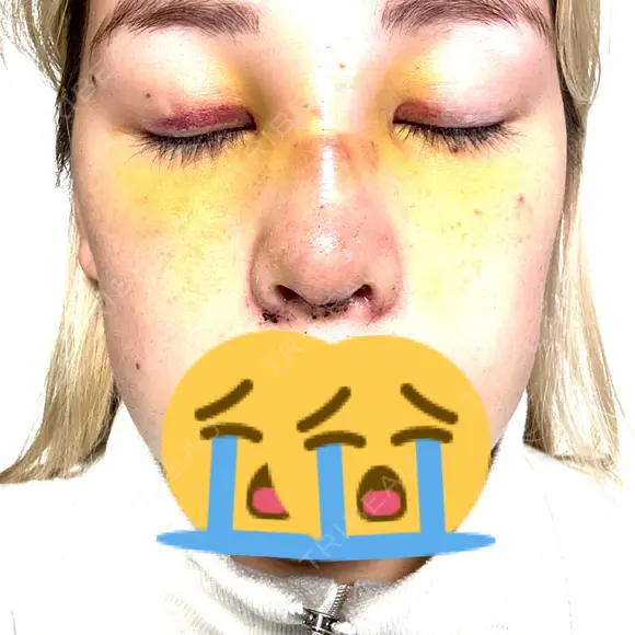 隆鼻術 / 鼻尖形成（切開） / 軟骨移植 / 小鼻縮小（非切開） X CLINIC 大阪院 DAY 4 メイン用