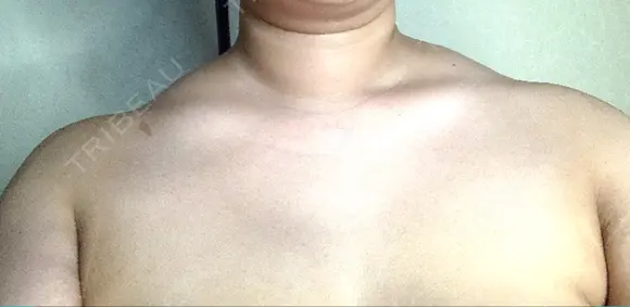 ボトックス（肩） ルラ美容クリニック 横浜院 DAY 2 メイン用