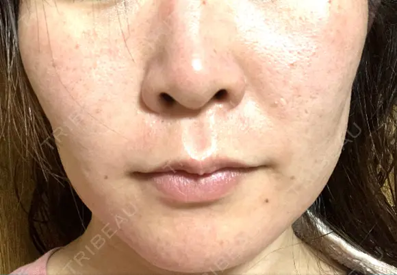 ヴェルヴェットスキン 聖心美容クリニック 広島院 DAY 1 メイン用