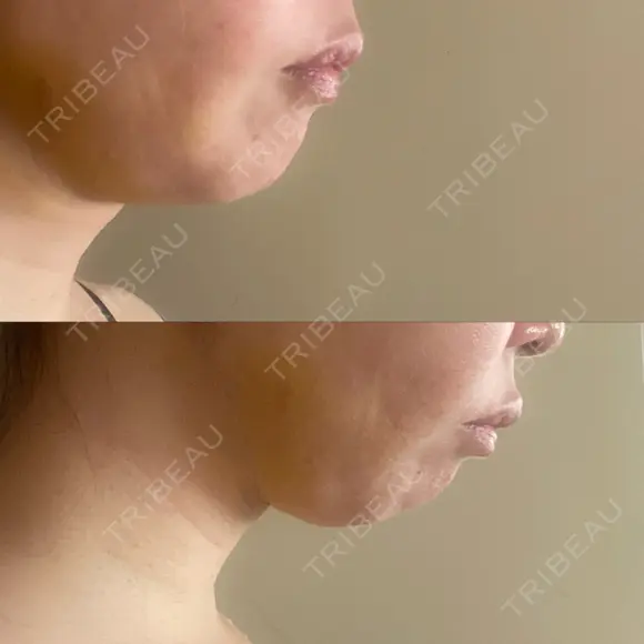 糸リフト / 脂肪吸引（顔） 自由が丘ウェルエイジングビューティークリニック DAY 4 メイン用