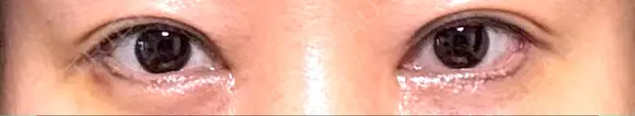 目尻切開 / タレ目形成・グラマラスライン（埋没） / 美容点滴・美容注射（美肌） LOUIS CLINIC 二子玉川院【ルイクリニック】 DAY 7 メイン用