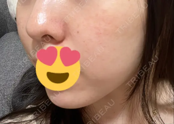 毛穴洗浄（ハイドラフェイシャルなど） 東京素肌クリニック 銀座本院 AFTER メイン用