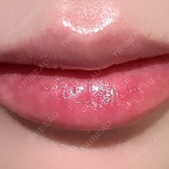 ヒアルロン酸注入（唇） NARU Beauty Clinic 【ナルクリ】 DAY 1 メイン用