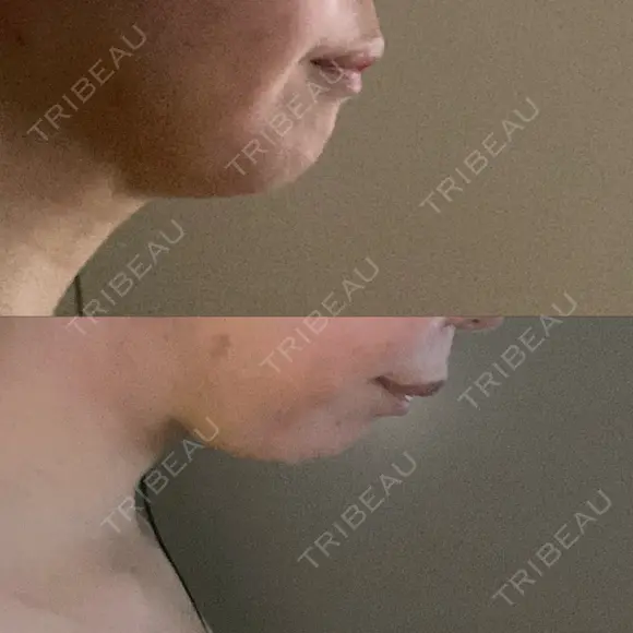 糸リフト / 脂肪吸引（顔） 自由が丘ウェルエイジングビューティークリニック DAY 6 メイン用