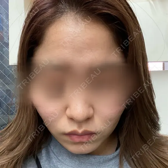 ダーマペン 美容皮膚科しらゆきクリニック AFTER メイン用
