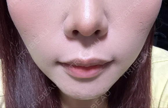 糸リフト 共立美容外科 梅田院 DAY 2 メイン用