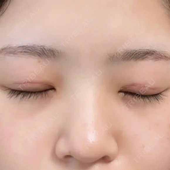 目頭切開 東京エビスクリニック DAY 17 メイン用