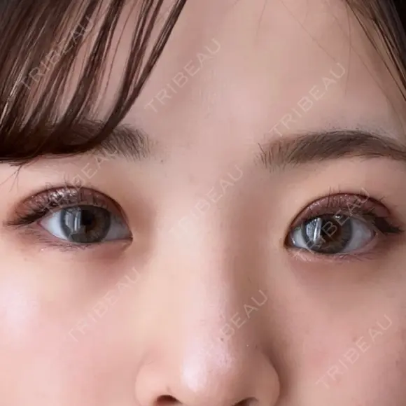 目頭切開 東京エビスクリニック DAY 17 メイン用