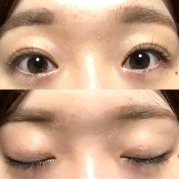 二重埋没 水の森美容クリニック 大阪梅田院 DAY 584 メイン用