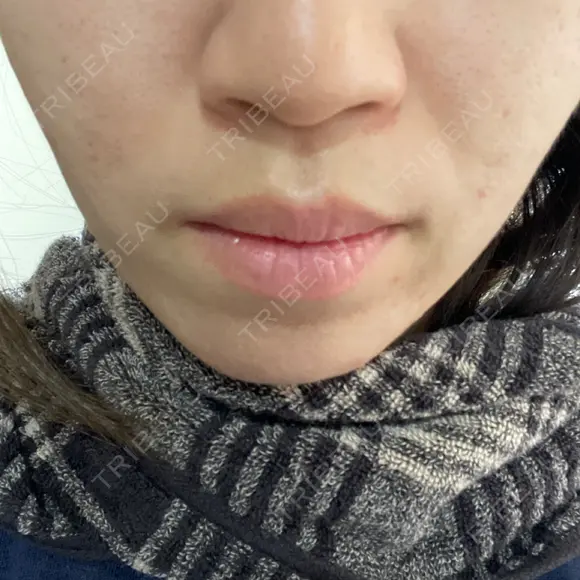 ダーマペン 若倉診療所 DAY 4 メイン用