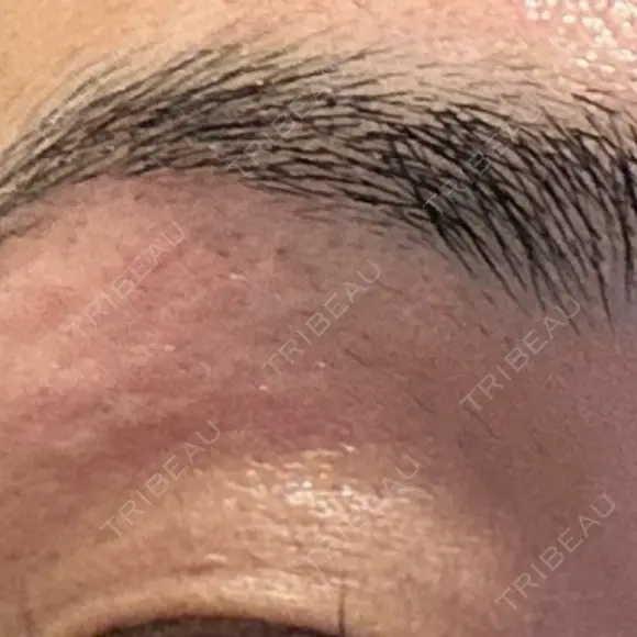 医療脱毛（顔） Jスキンクリニック 【J-SKIN clinic】 DAY 0 メイン用