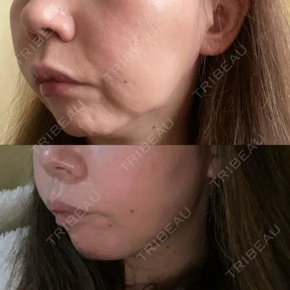 糸リフト / 脂肪吸引（顔） 自由が丘ウェルエイジングビューティークリニック DAY 8 メイン用