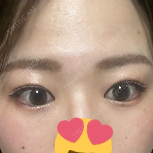 上まぶたの脂肪取り 9BeautyClinic DAY 15 メイン用