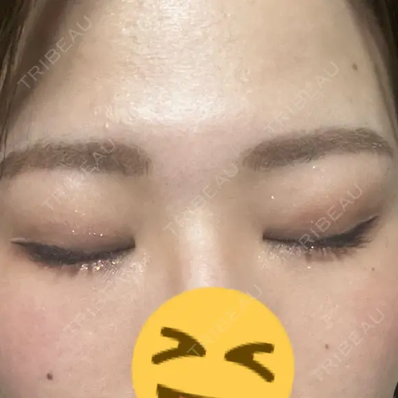 上まぶたの脂肪取り 9BeautyClinic DAY 15 メイン用