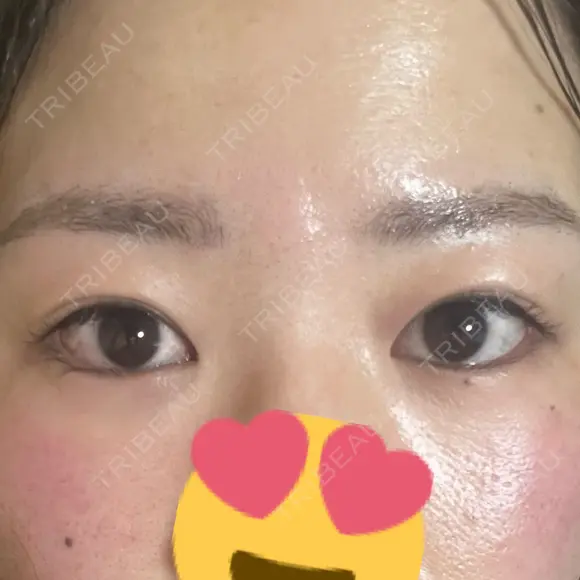 上まぶたの脂肪取り 9BeautyClinic DAY 16 メイン用