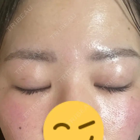 上まぶたの脂肪取り 9BeautyClinic DAY 16 メイン用