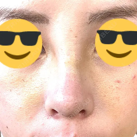 隆鼻術 / 鼻尖形成（切開） / 軟骨移植 / 小鼻縮小（非切開） X CLINIC 大阪院 DAY 10 メイン用